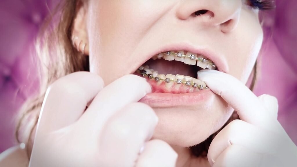 upgraded braces with chain-link rubber bands and nitrile gloves