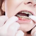 upgraded braces with chain-link rubber bands and nitrile gloves